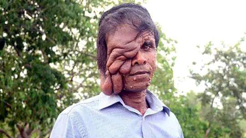 বিরল রোগে আক্রান্ত
